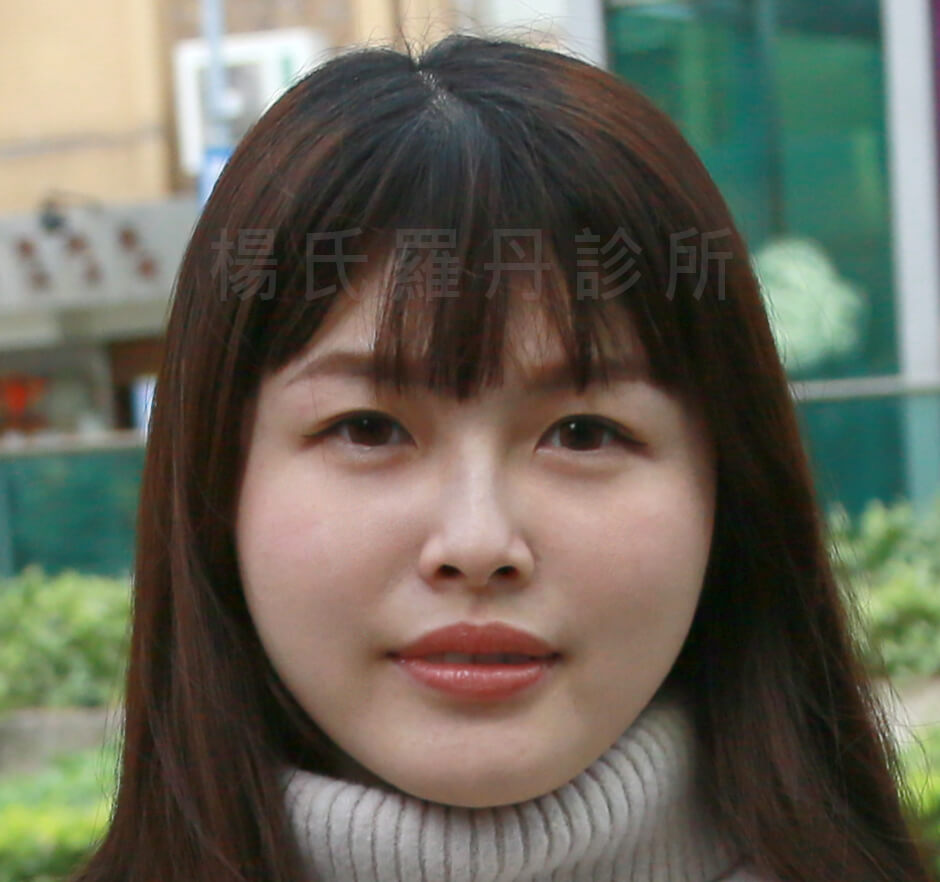 瘦臉 瘦下巴 雷射減脂 楊氏羅丹